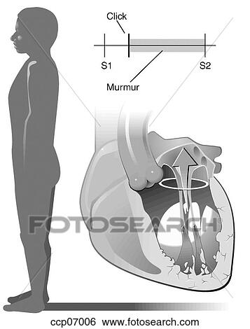 Stock Illustration - Mitral valve prolapse, supine position. Fotosearch