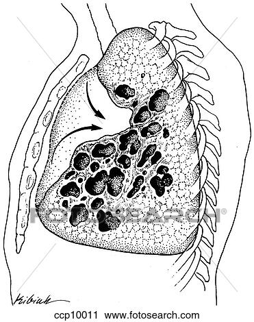 Clip Art - Mycobacterium kansasii infection. Fotosearch