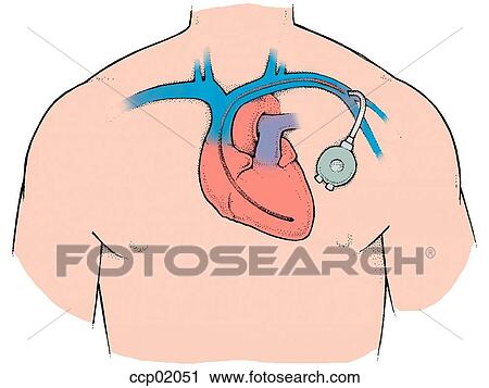 Pacemaker View Large Illustration Clip Art - Pacemaker. Fotosearch