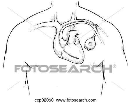 Pacemaker View Large Illustration Clipart - Pacemaker. Fotosearch