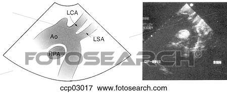 Plane, suprasternal View Large Illustration Stock Illustration - Plane, suprasternal. Fotosearch