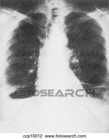 Pleural Effusion View Large Illustration Drawing - Pleural Effusion. Fotosearch