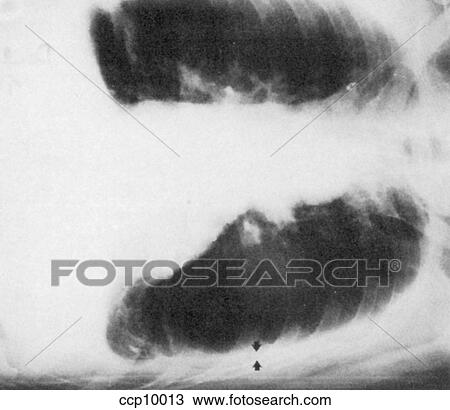 Pleural Effusion View Large Illustration Drawing - Pleural Effusion. Fotosearch