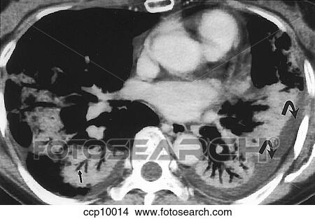 Pleural Effusion View Large Illustration Stock Illustration - Pleural Effusion. Fotosearch