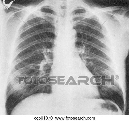 Radiograph, chest View Large Illustration Clipart - Radiograph, chest. Fotosearch