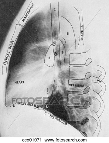 Clip Art - Radiograph, chest, lateral. Fotosearch