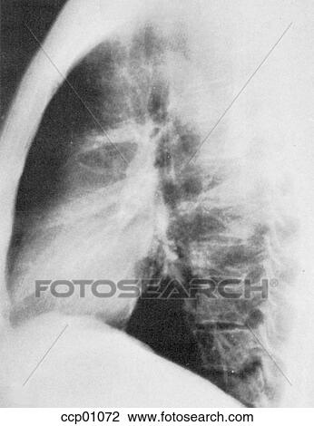 Radiograph, chest, lateral View Large Illustration Drawing - Radiograph, chest, lateral. Fotosearch