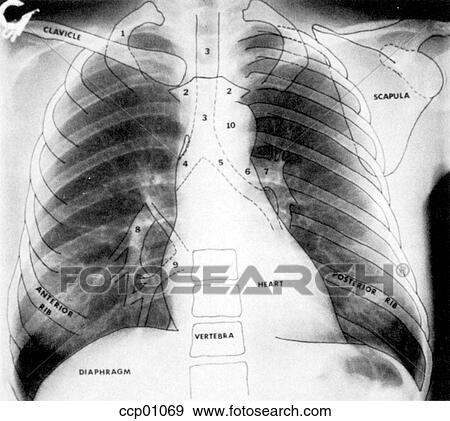 Radiograph, chest View Large Illustration Stock Illustration - Radiograph, chest. Fotosearch