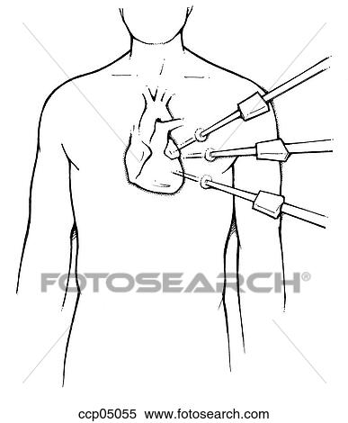 Stock Illustration - Surgery, coronary bypass. Fotosearch