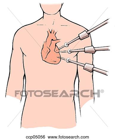 Stock Illustration - Surgery, coronary bypass. Fotosearch
