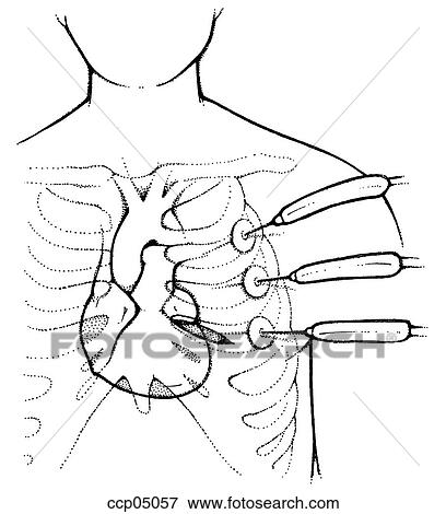 Stock Illustration - Surgery, coronary bypass. Fotosearch