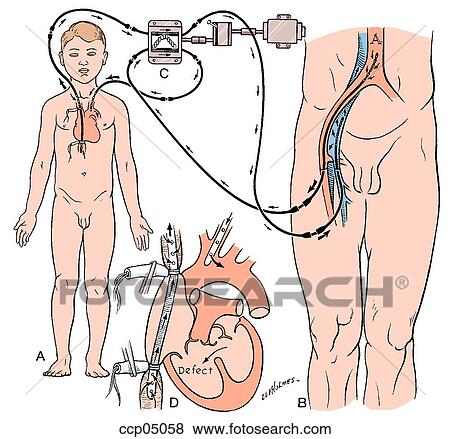 Surgery, intracardiac, direct-vision View Large Illustration Stock Illustration - Surgery, intracardiac, direct-vision. Fotosearch