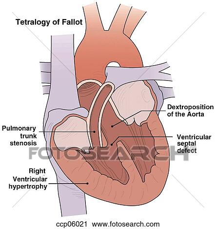 Clip Art - Tetralogy of Fallot. Fotosearch