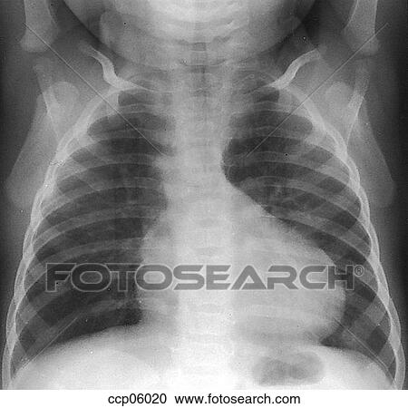 Clipart - Tetralogy of Fallot. Fotosearch