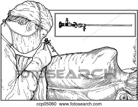 Thoracoscopy for diagnosis of pleural disease View Large Illustration Clipart - Thoracoscopy for diagnosis of pleural disease. Fotosearch