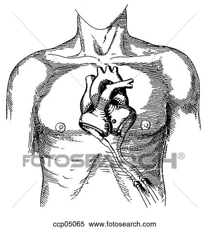 Stock Illustration - Total artificial heart. Fotosearch