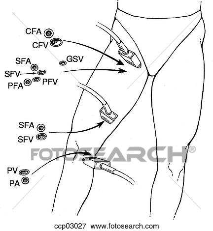 Stock Illustration - Ultrasound exam., deep venous. Fotosearch
