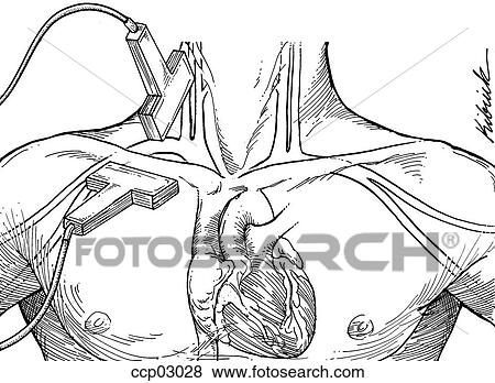 Ultrasound use for venipuncture View Large Illustration Stock Illustration - Ultrasound use for venipuncture. Fotosearch