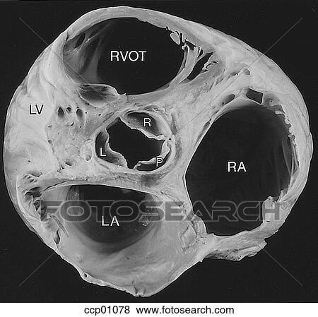 Stock Illustration - Valve, aortic. Fotosearch
