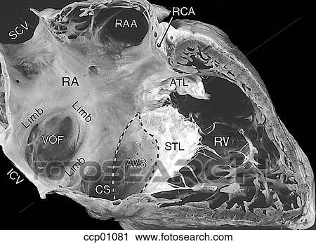 Clip Art - Valves, atrioventricular. Fotosearch