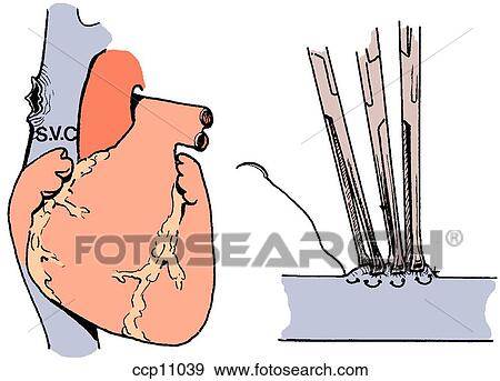 Stock Illustration - Venous tear, control. Fotosearch