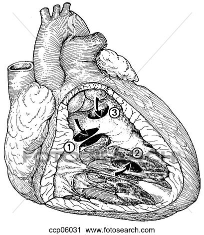 Clip Art - Ventricular septal defect. Fotosearch