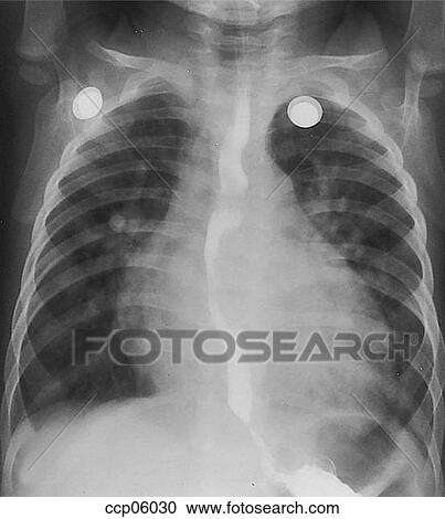 Ventricular septal defect View Large Illustration Clipart - Ventricular septal defect. Fotosearch