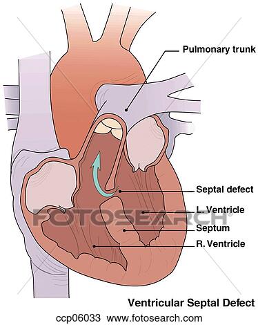 Drawing - Ventricular septal defects. Fotosearch