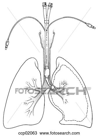 Drawing - Whole lung lavage. Fotosearch