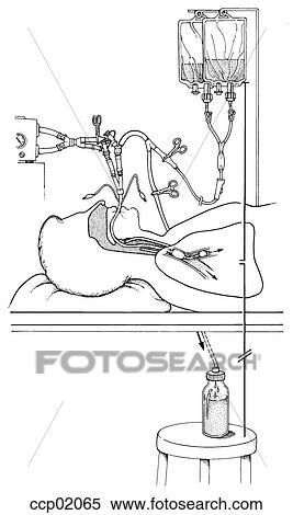 Stock Illustration - Whole lung lavage. Fotosearch