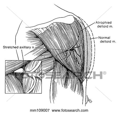 肩 腋窩の神経 圧縮 イラスト Mm Fotosearch
