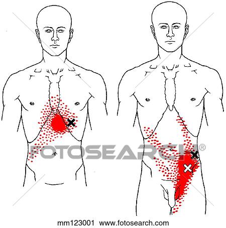 Abdominus obliqui m., trigger points View Large Illustration Clip Art - Abdominus obliqui m., trigger points. Fotosearch