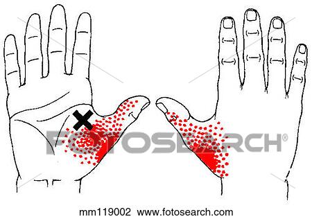 Drawing - Adductor pollicis m., trigger points. Fotosearch