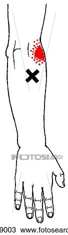 Anconius m., trigger points View Large Illustration Drawing - Anconius m., trigger points. Fotosearch
