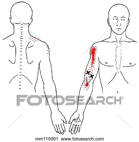 Biceps brachii m., trigger points View Large Illustration Clip Art - Biceps brachii m., trigger points. Fotosearch
