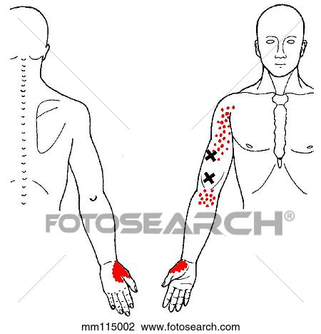 Brachialis m., trigger points View Large Illustration Drawing - Brachialis m., trigger points. Fotosearch