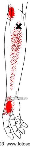 Drawing - Brachioradialis m., trigger points. Fotosearch