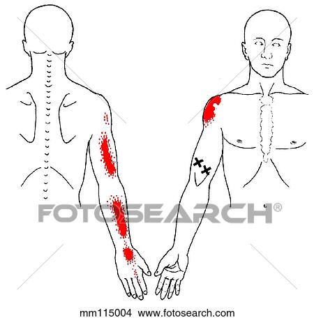 Coracobrachialis m., trigger points View Large Illustration Stock Illustration - Coracobrachialis m., trigger points. Fotosearch