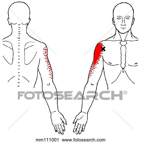 Clip Art - Deltoid m., trigger points. Fotosearch