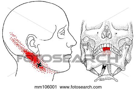 Clip Art - Digastric m., trigger points. Fotosearch