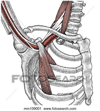 Entrapment, lower brachial plexus Clip Art | mm109001 | Fotosearch