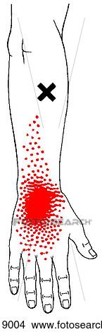 Extensor carpi radialis brevis m., trigger points View Large Illustration Stock Illustration - Extensor carpi radialis brevis m., trigger points. Fotosearch
