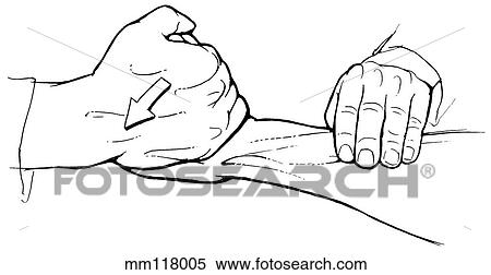 Stock Illustration - Extensor carpi radialis brevis. Fotosearch