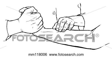 Extensor carpi radialis palpation View Large Illustration Stock Illustration - Extensor carpi radialis palpation. Fotosearch