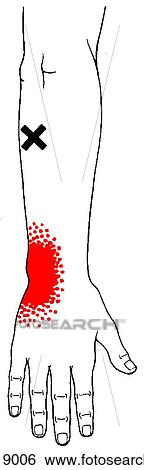 Extensor carpi ulnaris m., trigger points View Large Illustration Stock Illustration - Extensor carpi ulnaris m., trigger points. Fotosearch