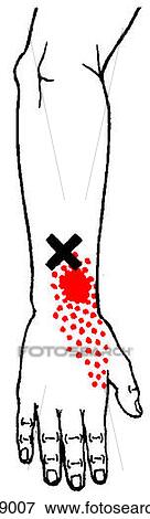 Extensor indices m., trigger points View Large Illustration Stock Illustration - Extensor indices m., trigger points. Fotosearch