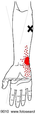 Flexor carpi radialis m., trigger points View Large Illustration Clipart - Flexor carpi radialis m., trigger points. Fotosearch