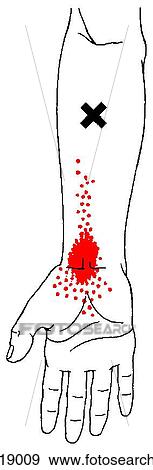 Stock Illustration - Flexor carpi radialis m., trigger points. Fotosearch