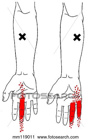 Flexor digitorum m., trigger points View Large Illustration Clip Art - Flexor digitorum m., trigger points. Fotosearch
