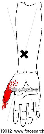 Drawing - Flexor pollicis longus m., trigger points. Fotosearch
